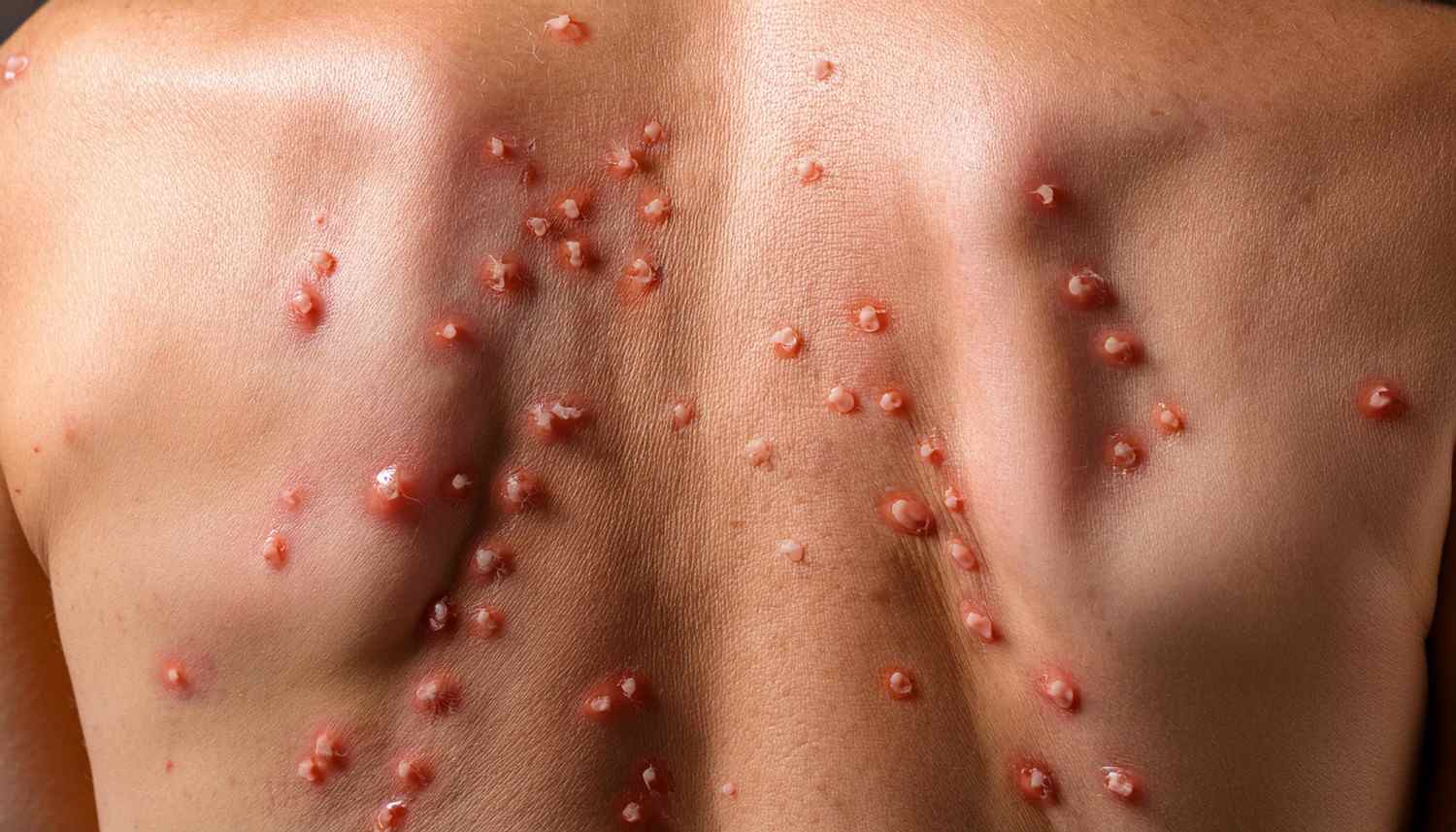 Shingles – Common Questions